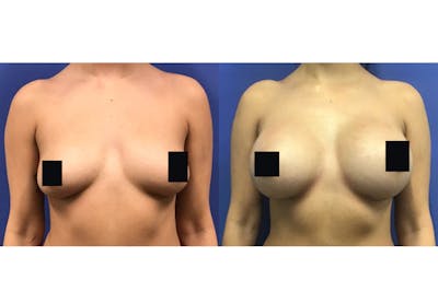 Breast Augmentation Before & After Gallery - Patient 192303549 - Image 1