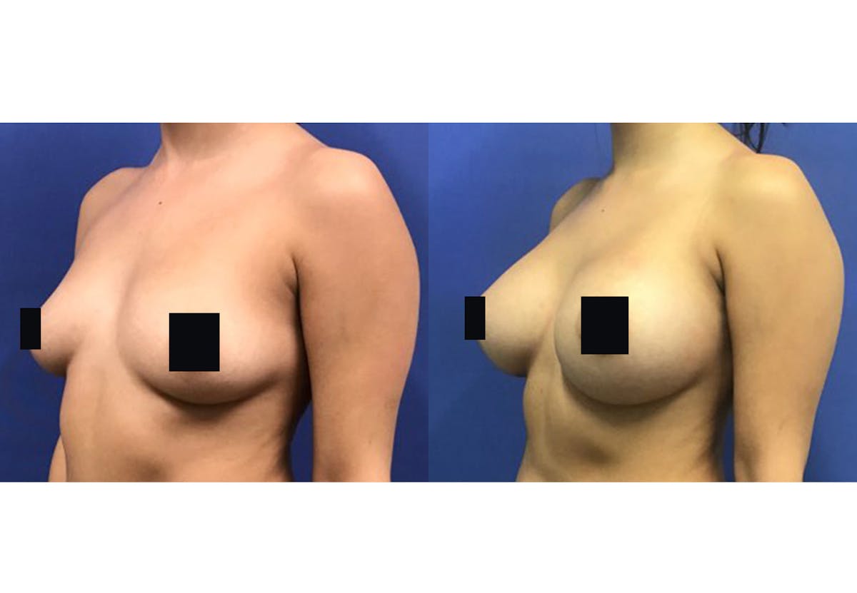 Breast Augmentation Before & After Gallery - Patient 192303549 - Image 2