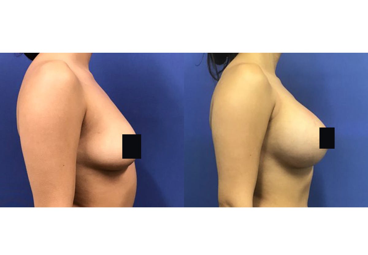 Breast Augmentation Before & After Gallery - Patient 192303549 - Image 3
