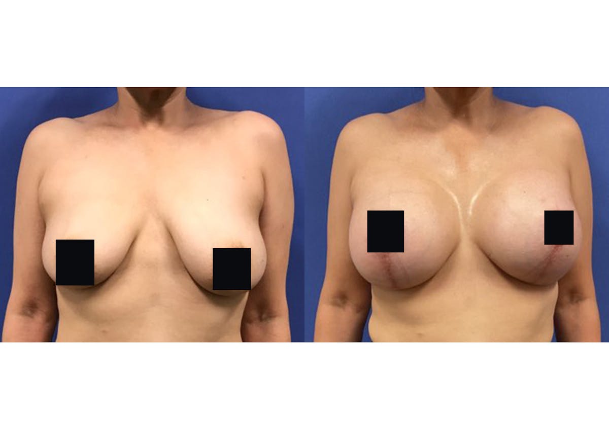 Breast Lift With Augmentation Before & After Gallery - Patient 192303655 - Image 1