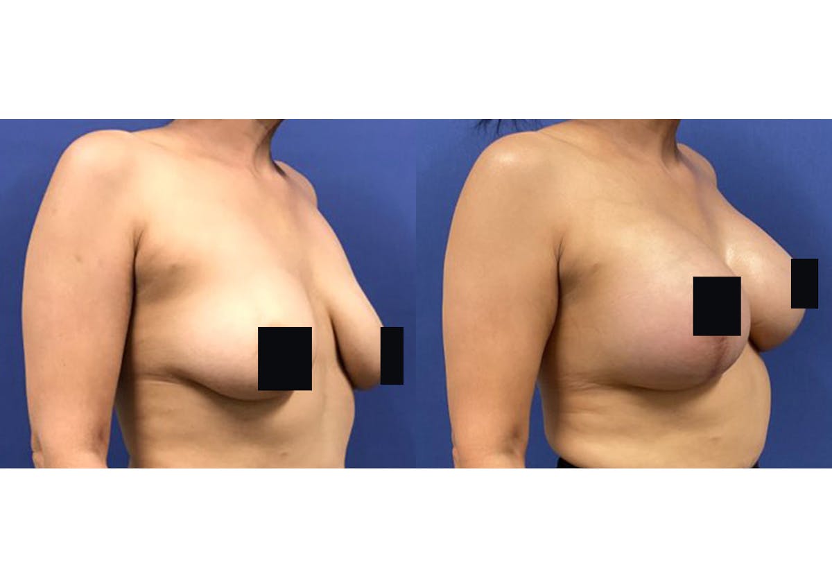 Breast Lift With Augmentation Before & After Gallery - Patient 192303655 - Image 2
