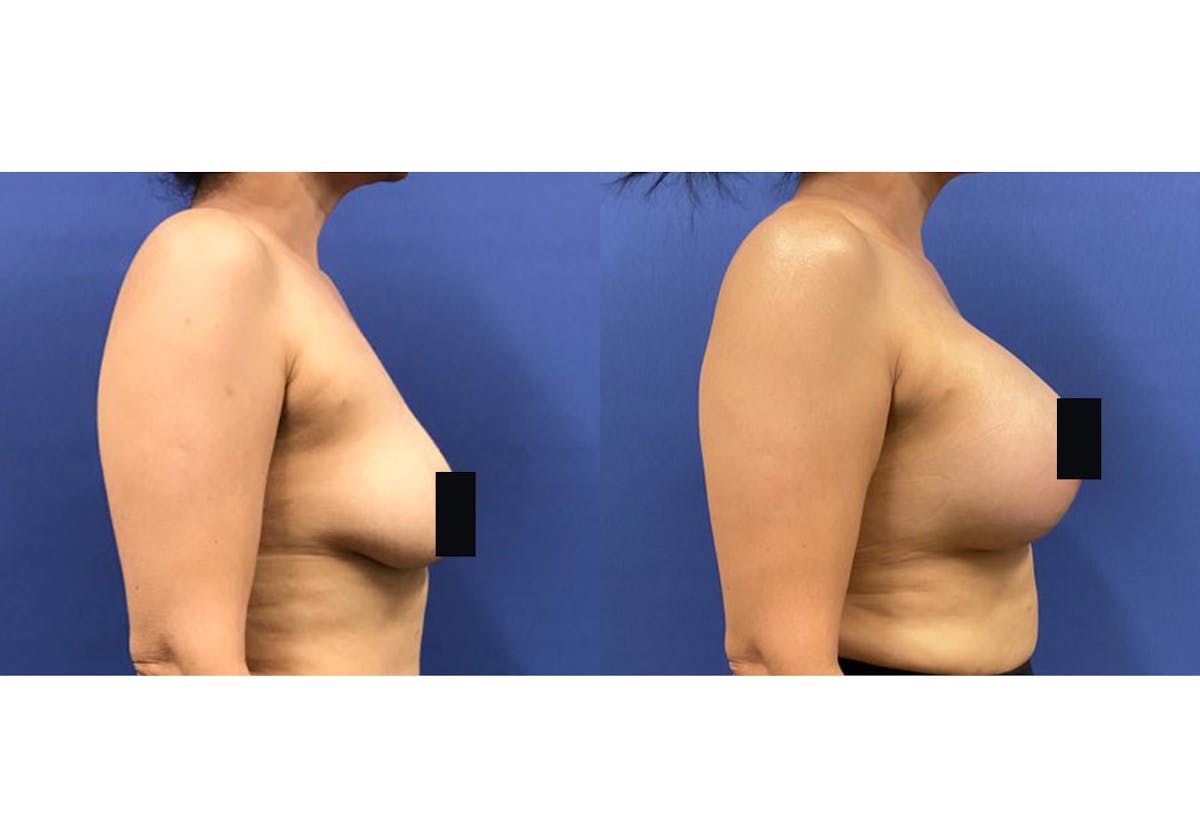 Breast Lift With Augmentation Before & After Gallery - Patient 192303655 - Image 3