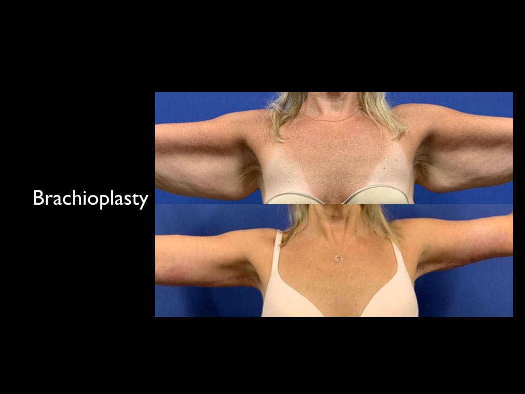 procedure