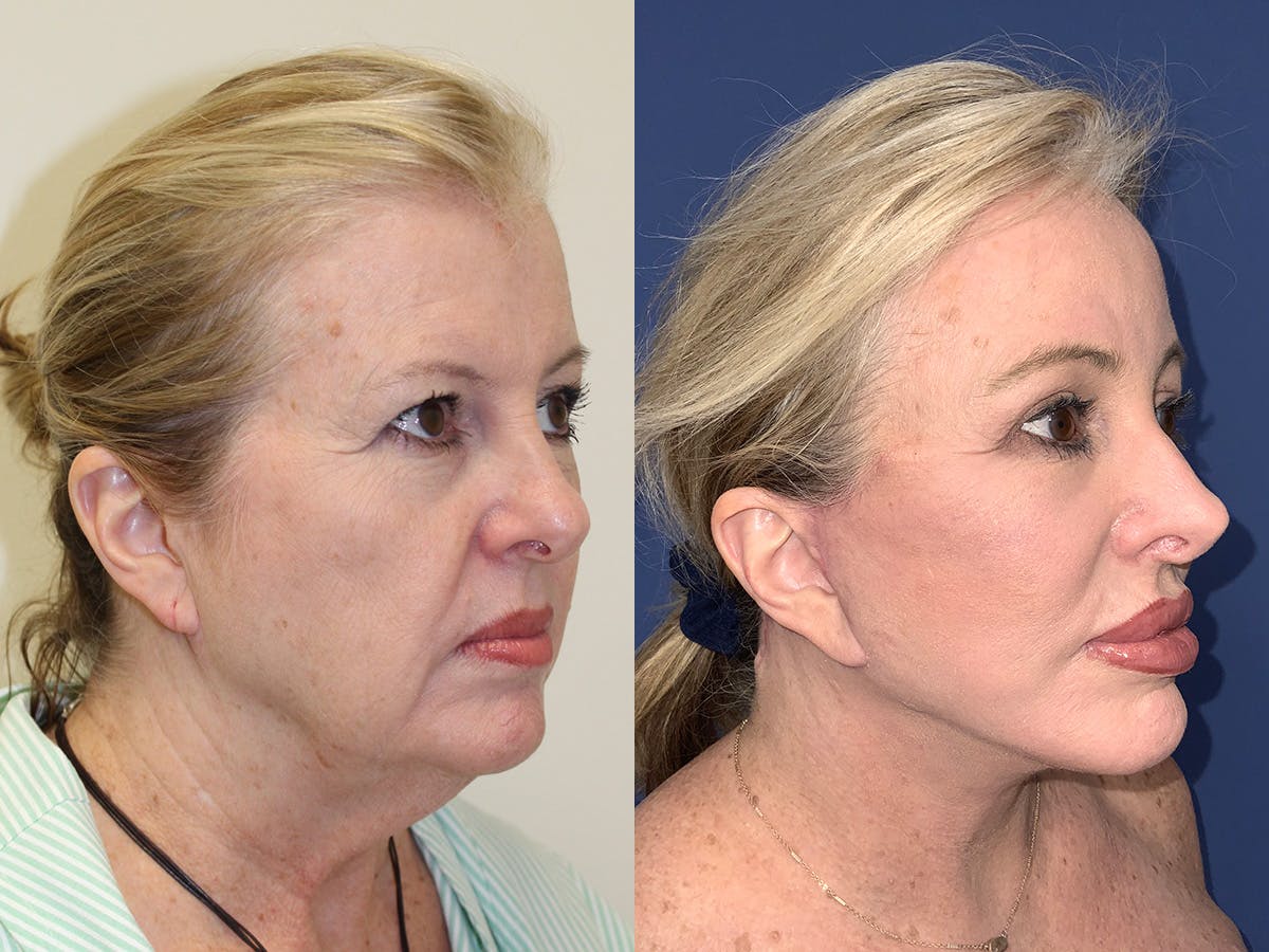 Brow Lift Before & After Gallery - Patient 377093 - Image 1