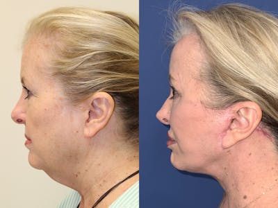 Rhinoplasty Before & After Gallery - Patient 427188 - Image 1