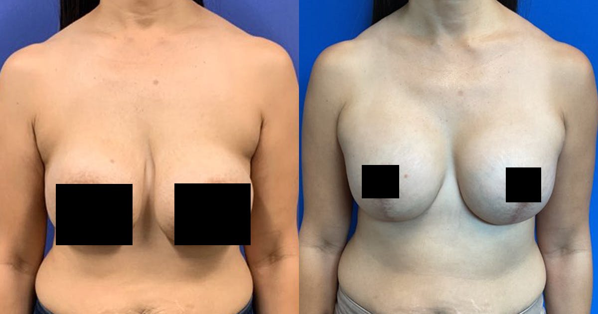 Breast Revision Before & After Gallery - Patient 883566 - Image 1