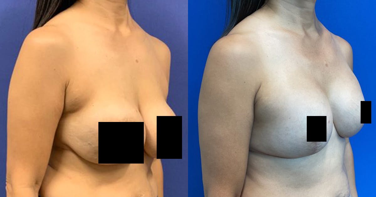 Breast Revision Before & After Gallery - Patient 883566 - Image 2