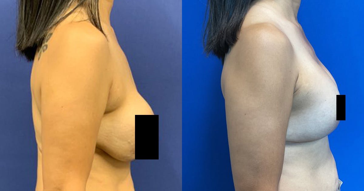 Breast Revision Before & After Gallery - Patient 883566 - Image 3