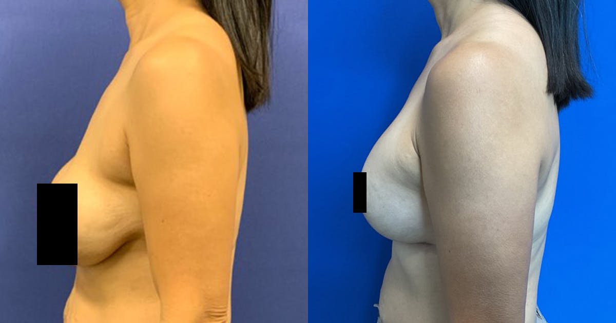 Breast Revision Before & After Gallery - Patient 883566 - Image 4