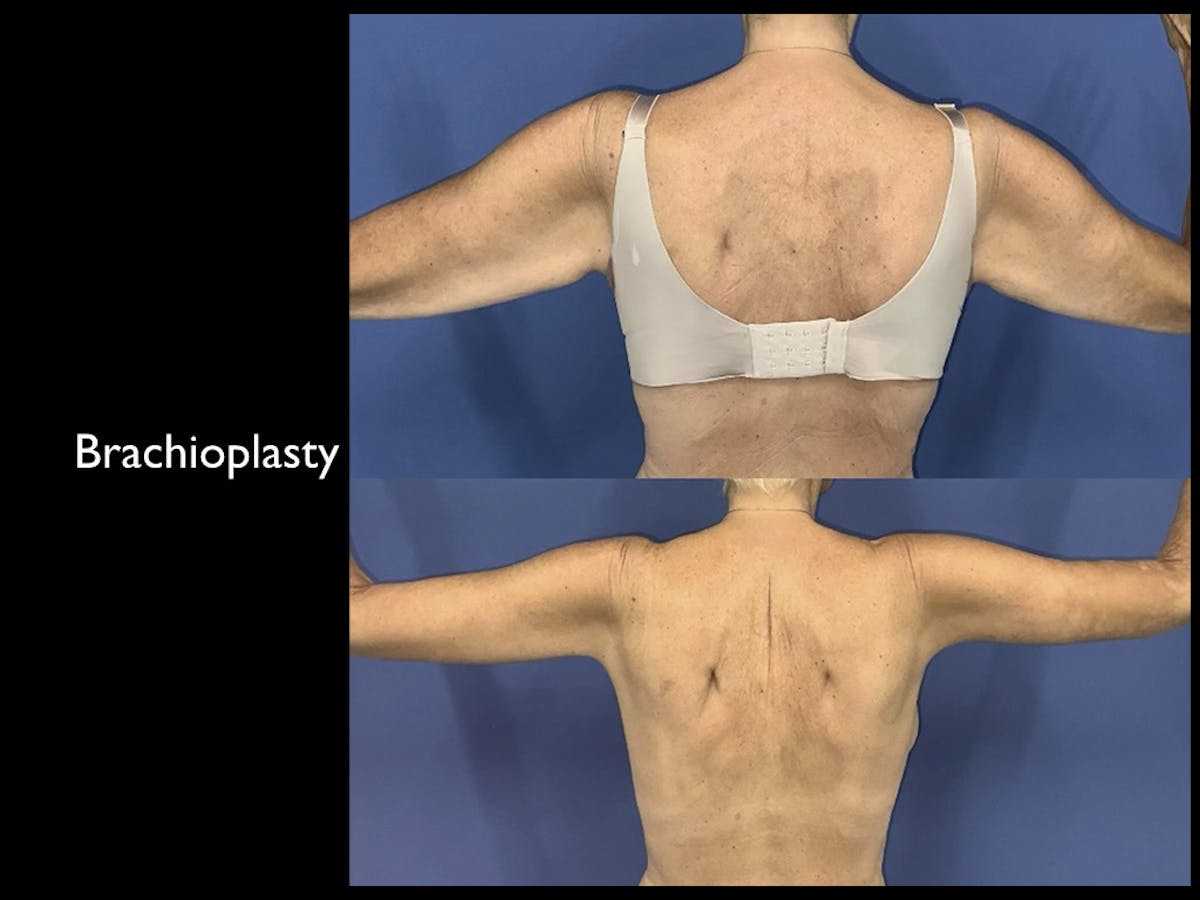 Arm Lift Before & After Gallery - Patient 395442 - Image 1