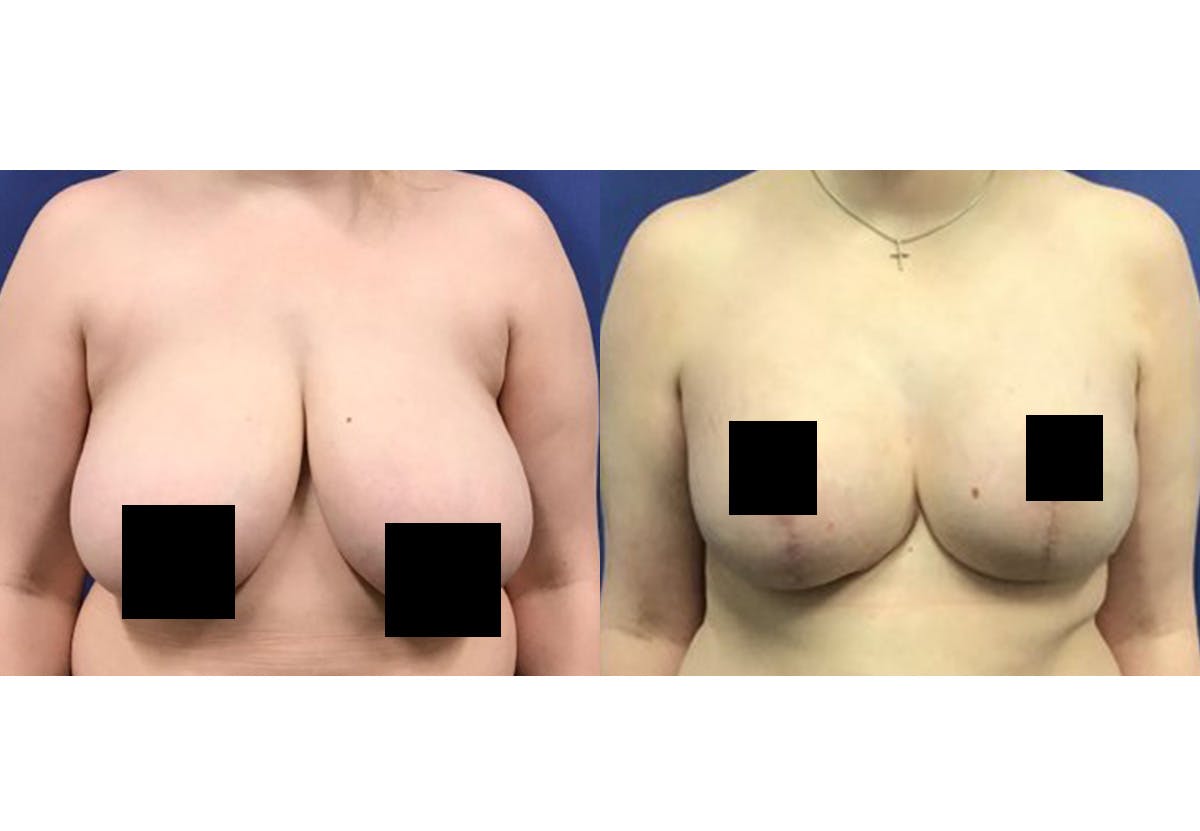 Breast Lift With Augmentation Before & After Gallery - Patient 418302 - Image 1