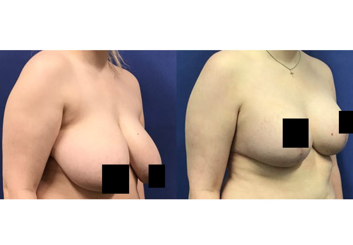 Breast Lift With Augmentation Before & After Gallery - Patient 418302 - Image 2