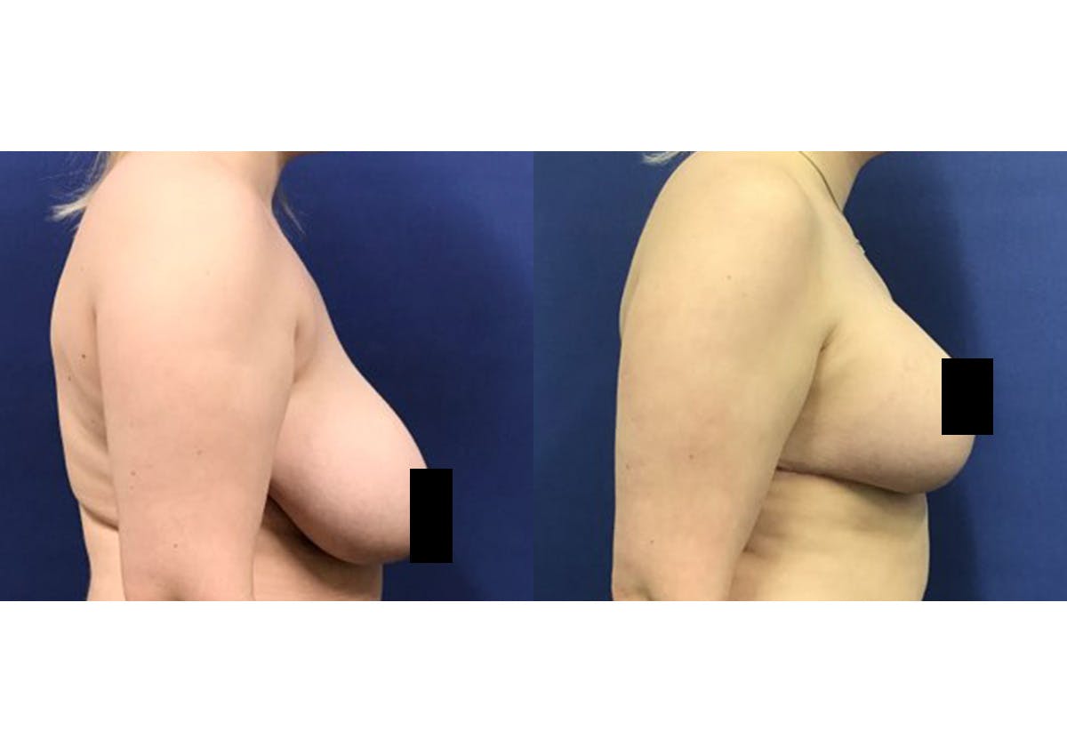 Breast Lift With Augmentation Before & After Gallery - Patient 418302 - Image 3