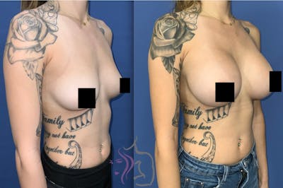 Breast Augmentation Before & After Gallery - Patient 412820 - Image 1