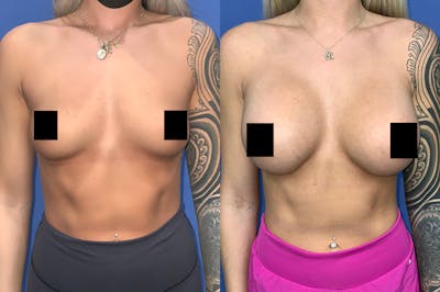 Breast Augmentation Before & After Gallery - Patient 207914 - Image 1