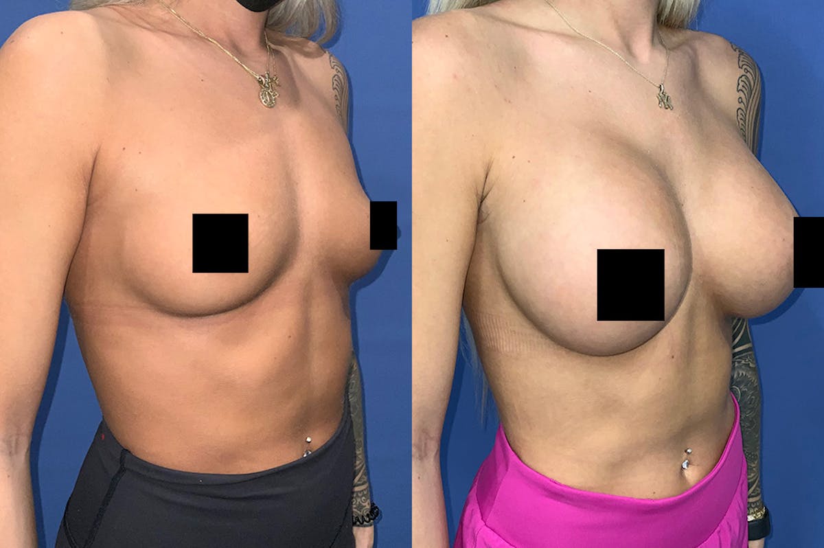 Breast Augmentation Before & After Gallery - Patient 207914 - Image 2