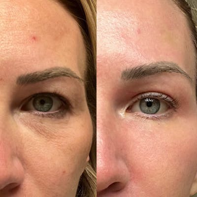 CO2 Laser Resurfacing Before & After Gallery - Patient 385442 - Image 1