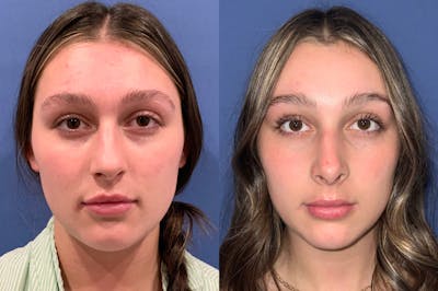 Rhinoplasty Before & After Gallery - Patient 360261 - Image 1