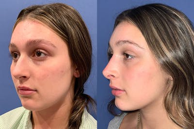 Rhinoplasty Before & After Gallery - Patient 360261 - Image 1