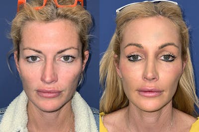 Brow Lift Before & After Gallery - Patient 882660 - Image 1