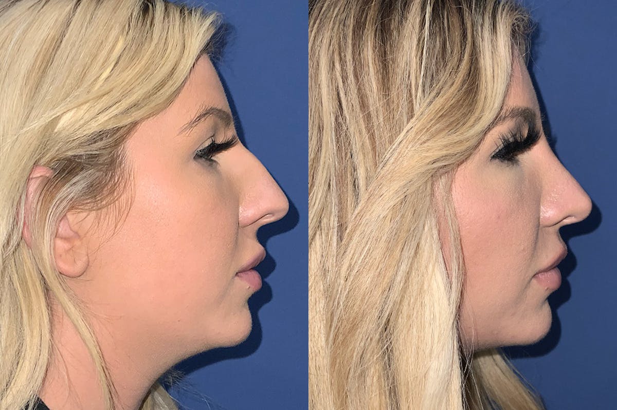 Rhinoplasty Before & After Gallery - Patient 304111 - Image 1