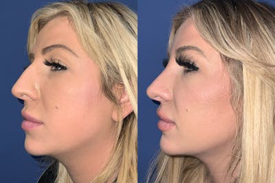 Rhinoplasty Before & After Gallery - Patient 304111 - Image 1