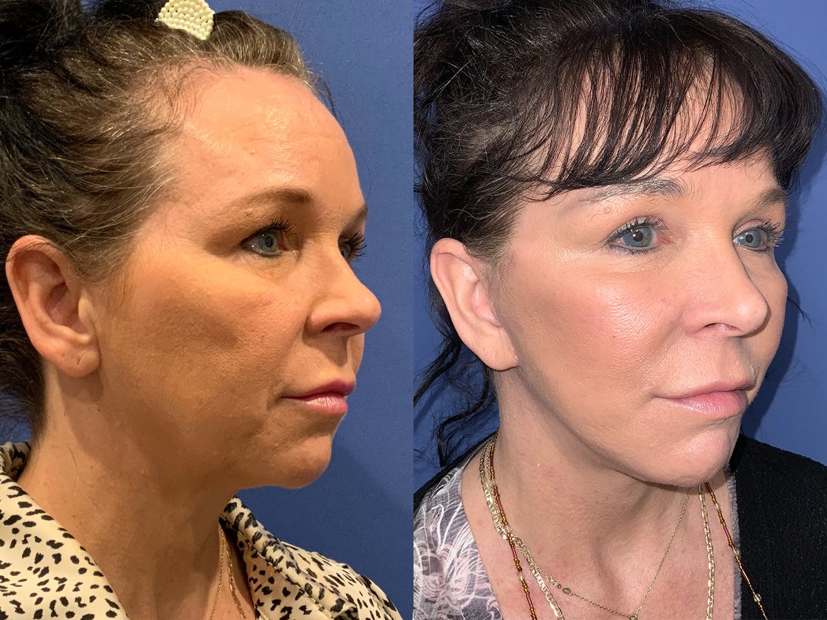 Facelift Before & After Gallery - Patient 369913 - Image 1