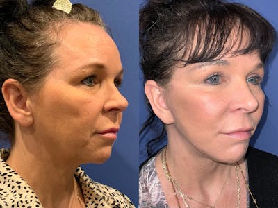 Facelift Before & After Gallery - Patient 369913 - Image 1