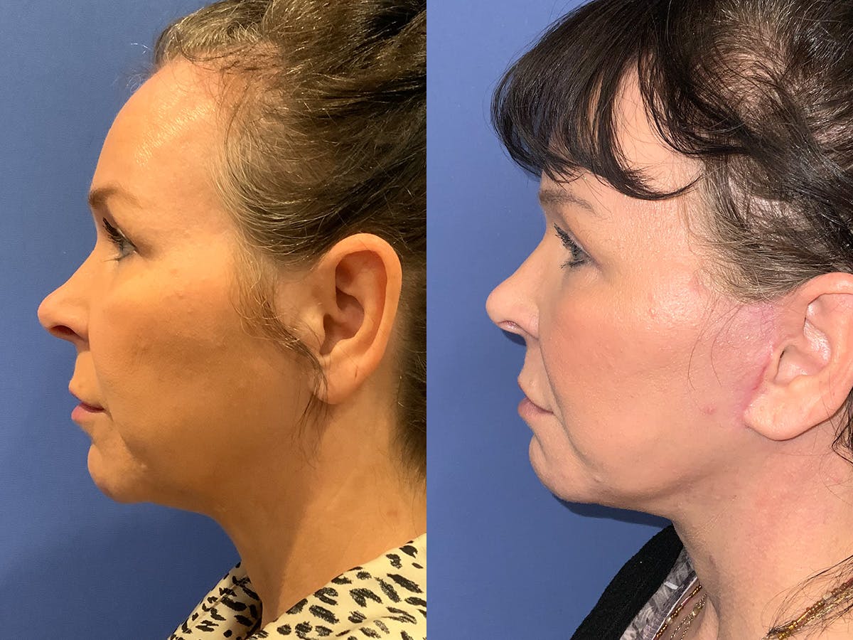 Neck Lift Before & After Gallery - Patient 190382 - Image 2