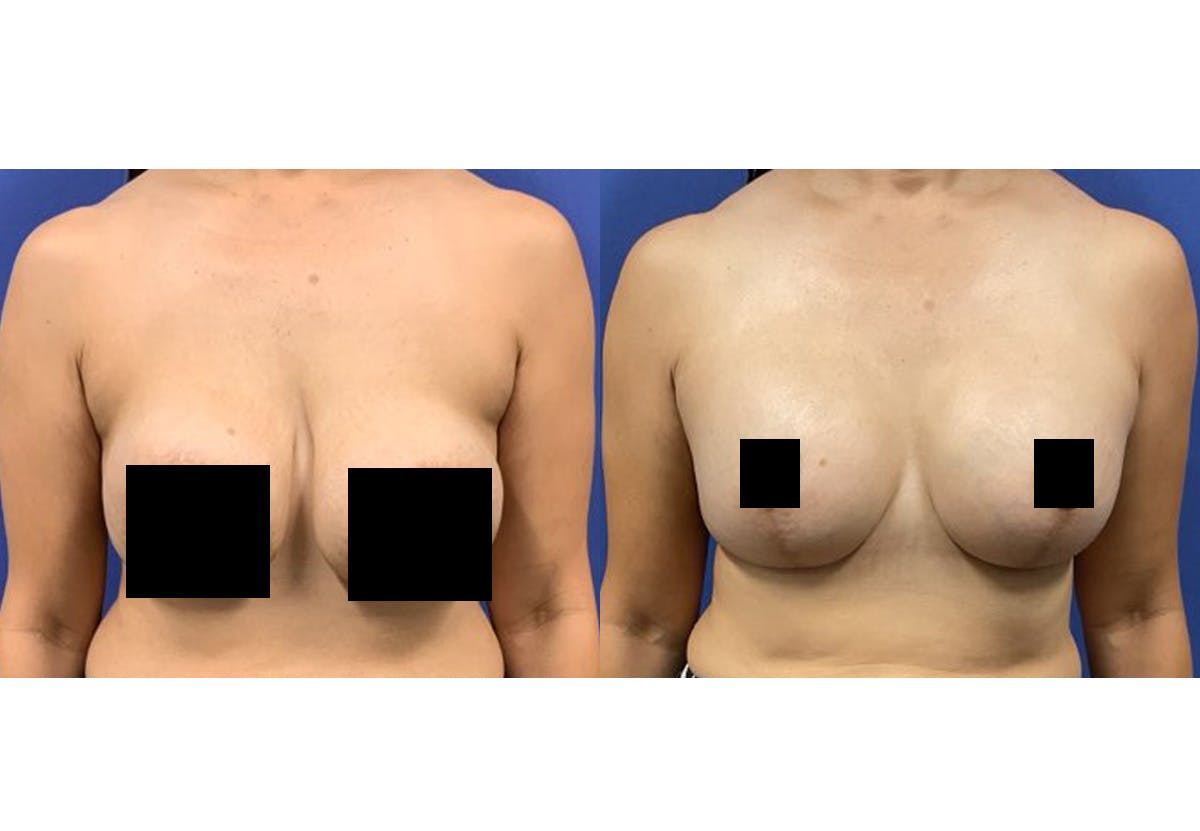 Breast Lift With Augmentation Before & After Gallery - Patient 139221 - Image 1