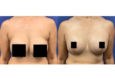 Breast Lift With Augmentation Before & After Gallery - Patient 139221 - Image 1