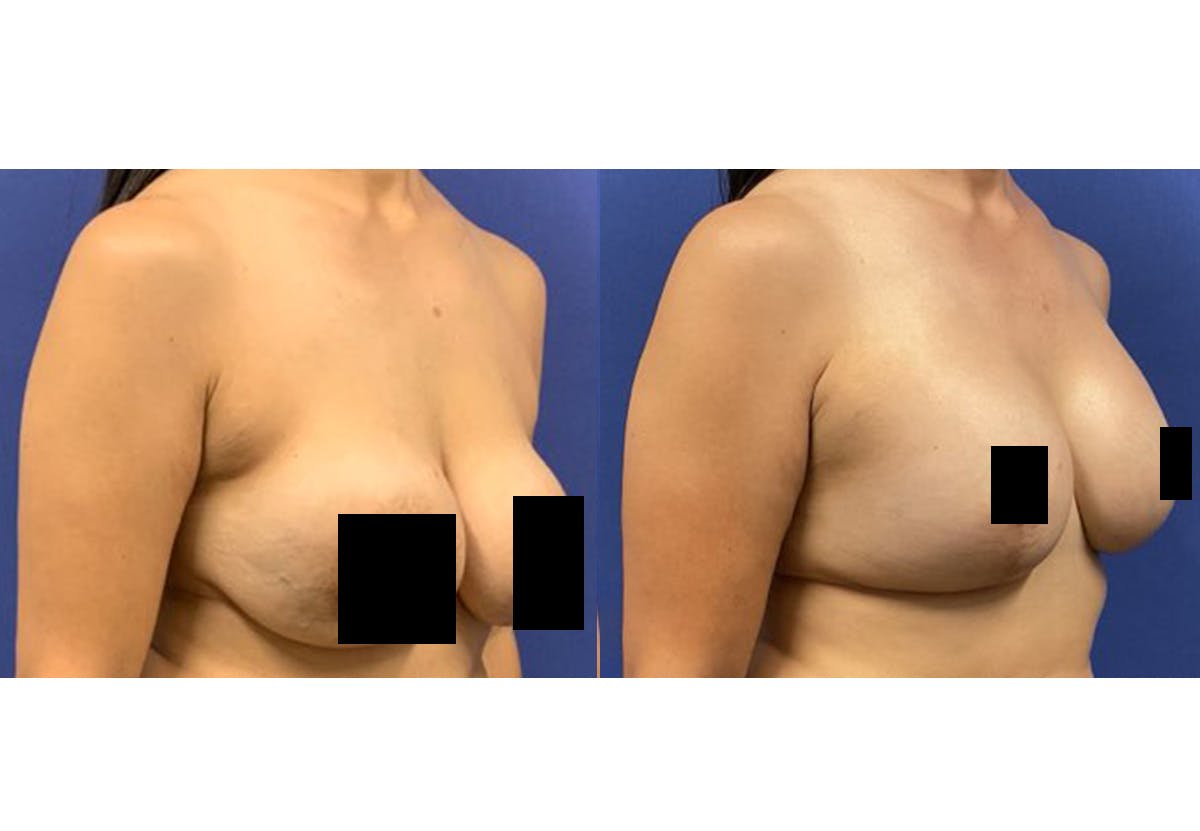 Breast Lift With Augmentation Before & After Gallery - Patient 139221 - Image 2