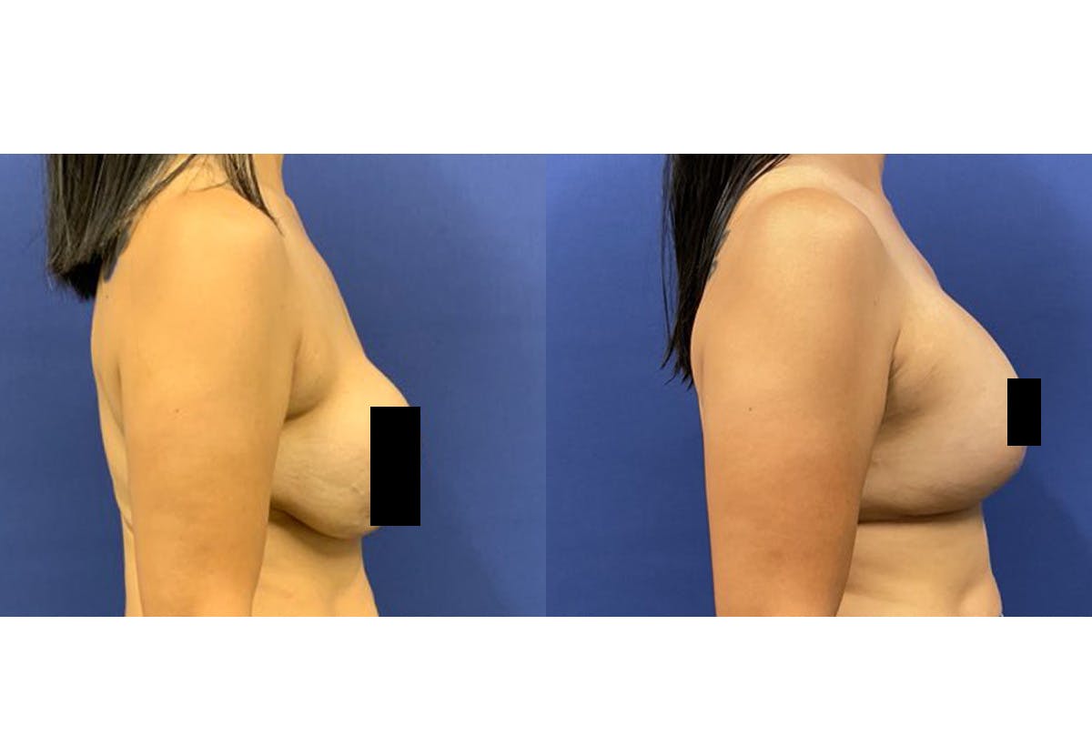Breast Lift With Augmentation Before & After Gallery - Patient 139221 - Image 3