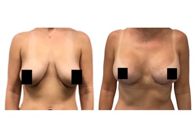 Breast Lift With Augmentation Before & After Gallery - Patient 385306 - Image 1