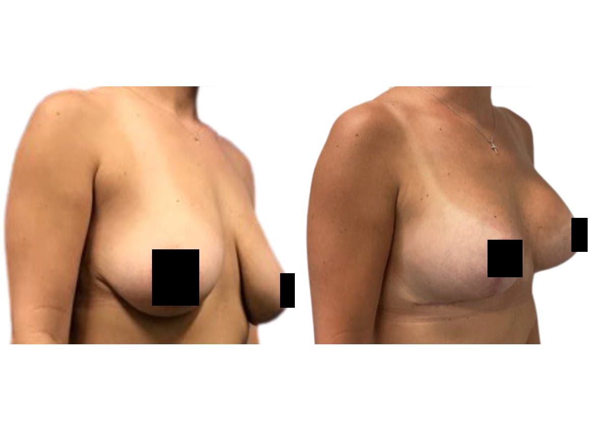 Breast Lift With Augmentation Before & After Gallery - Patient 385306 - Image 2