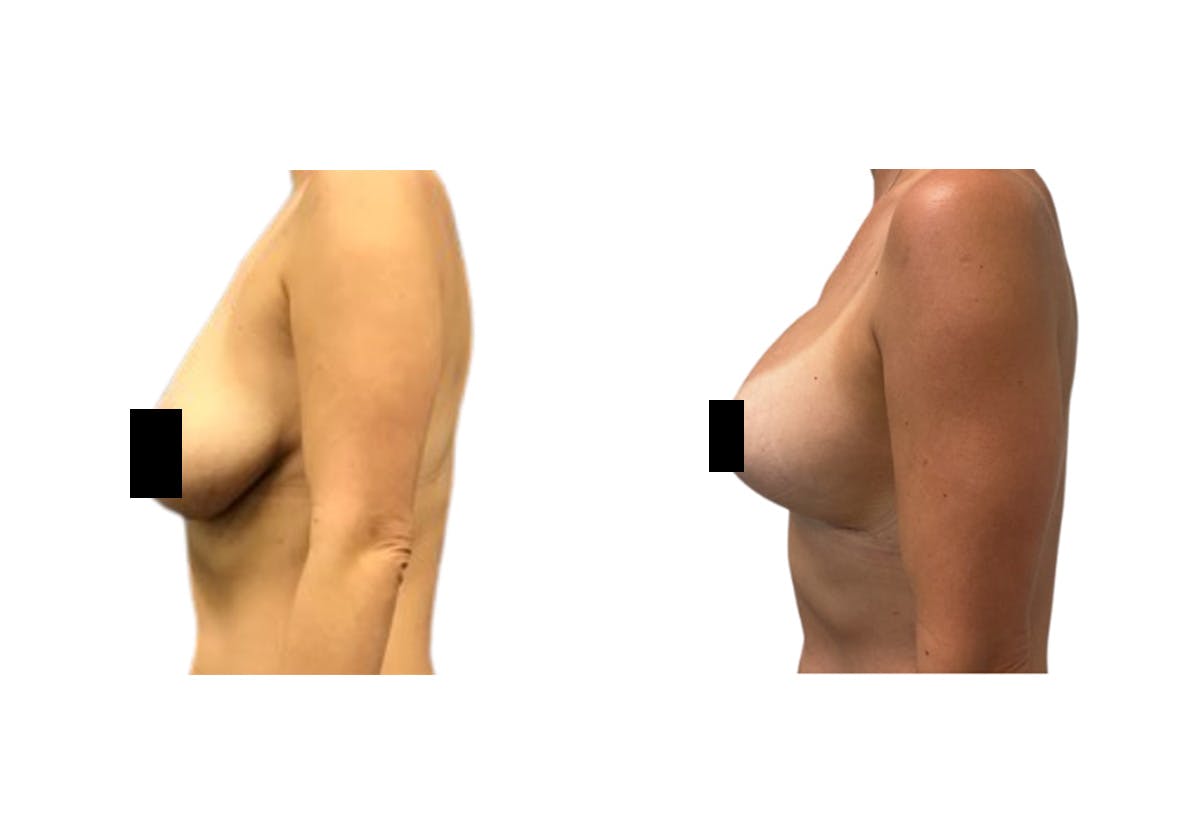 Breast Lift With Augmentation Before & After Gallery - Patient 385306 - Image 3