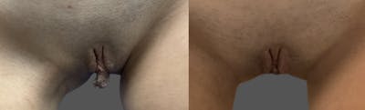 Labiaplasty Before & After Gallery - Patient 193582 - Image 1