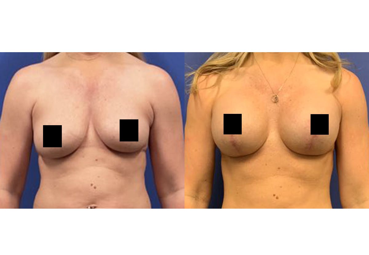 Breast Lift With Augmentation Before & After Gallery - Patient 116754 - Image 1