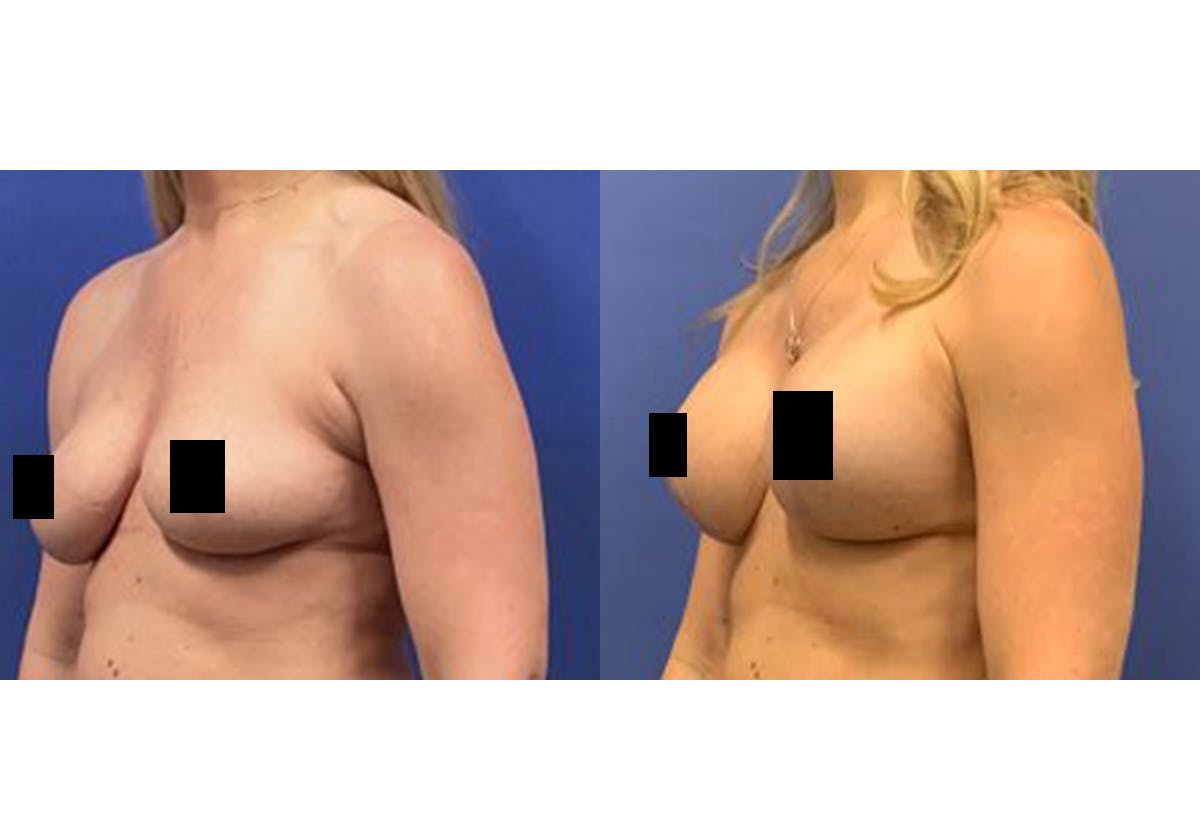 Breast Lift With Augmentation Before & After Gallery - Patient 116754 - Image 2