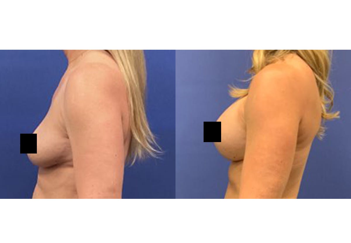 Breast Lift With Augmentation Before & After Gallery - Patient 116754 - Image 3