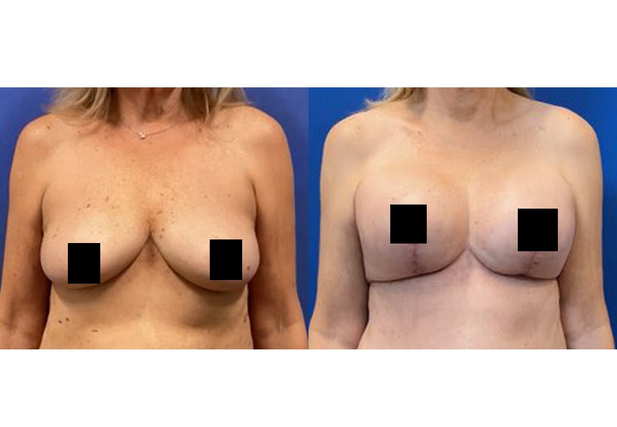 Breast Lift With Augmentation Before & After Gallery - Patient 408238 - Image 1