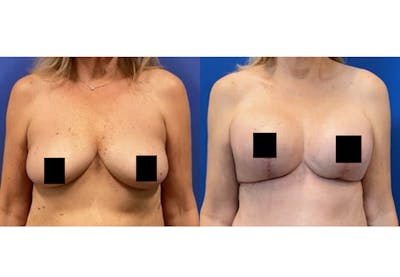 Breast Lift With Augmentation Before & After Gallery - Patient 408238 - Image 1