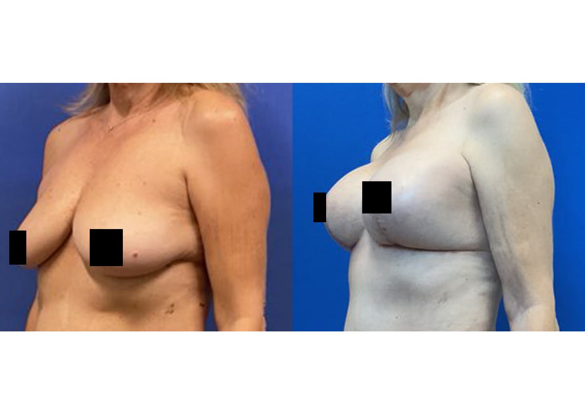 Breast Lift With Augmentation Before & After Gallery - Patient 408238 - Image 2
