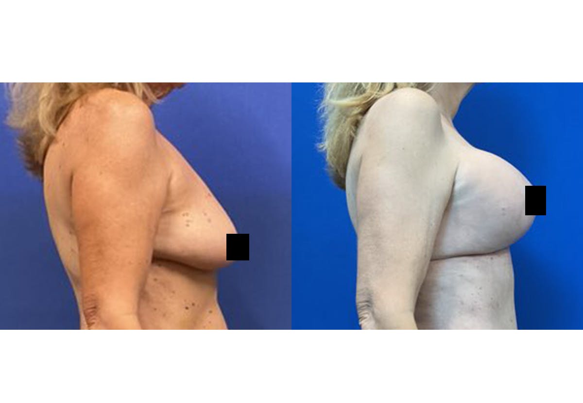 Breast Lift With Augmentation Before & After Gallery - Patient 408238 - Image 3