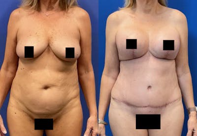 Liposuction Before & After Gallery - Patient 253541 - Image 1