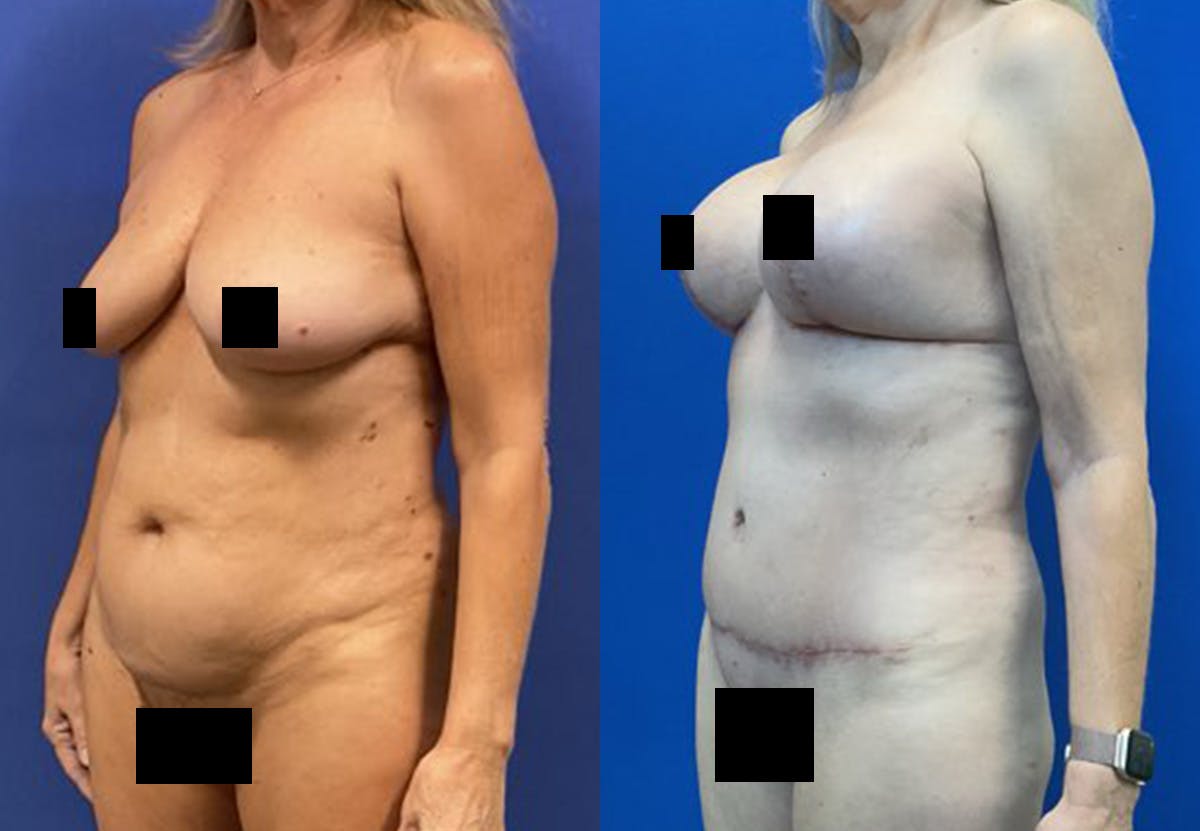 Liposuction Before & After Gallery - Patient 253541 - Image 2