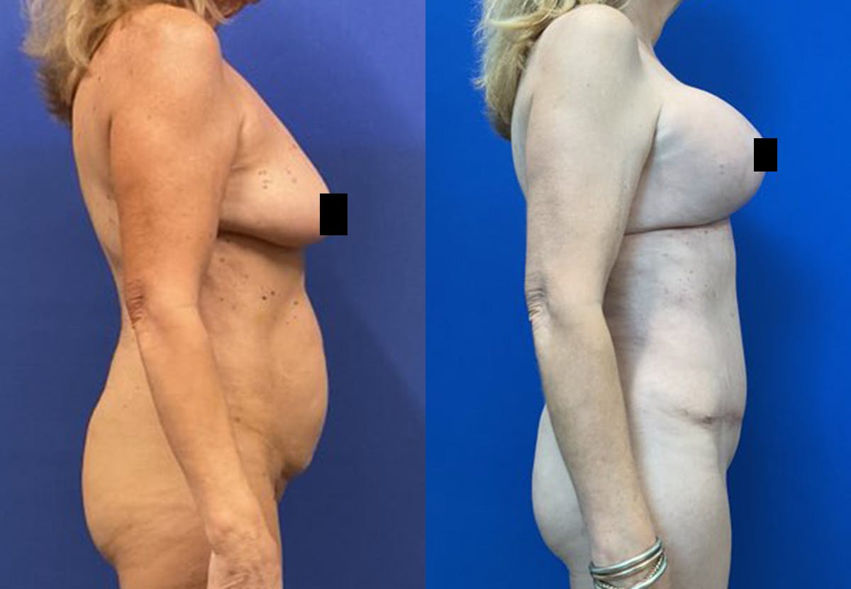 Liposuction Before & After Gallery - Patient 253541 - Image 3