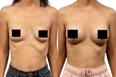 Breast Augmentation Before & After Gallery - Patient 244319 - Image 1