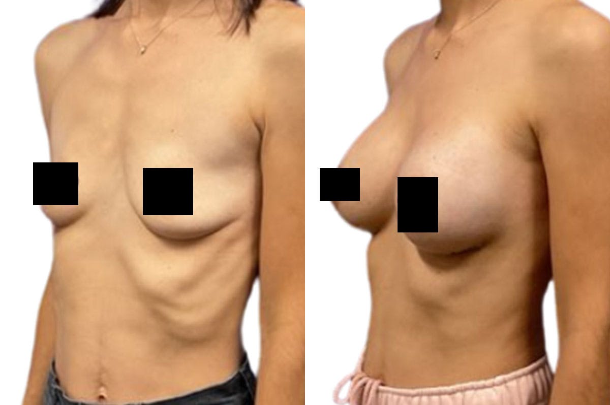 Breast Augmentation Before & After Gallery - Patient 244319 - Image 2