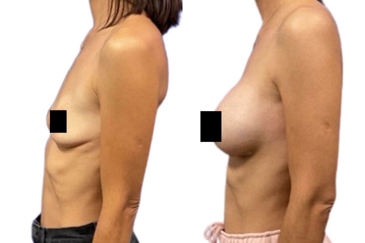 Breast Augmentation Before & After Gallery - Patient 244319 - Image 3